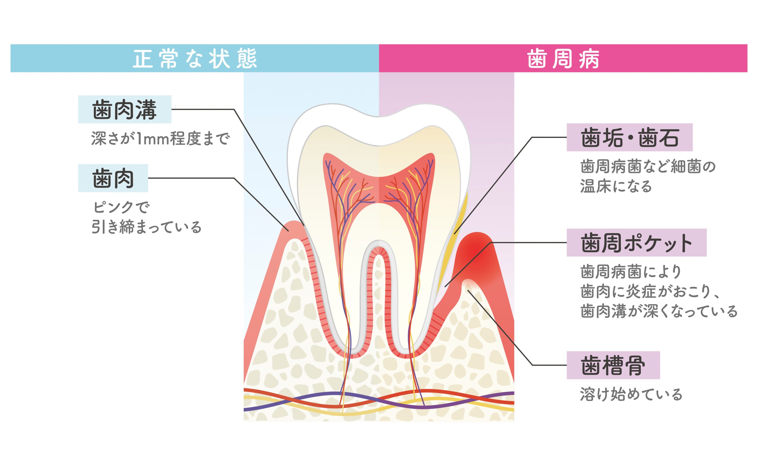 歯周病になりやすい人となりにくい人の特徴とは？