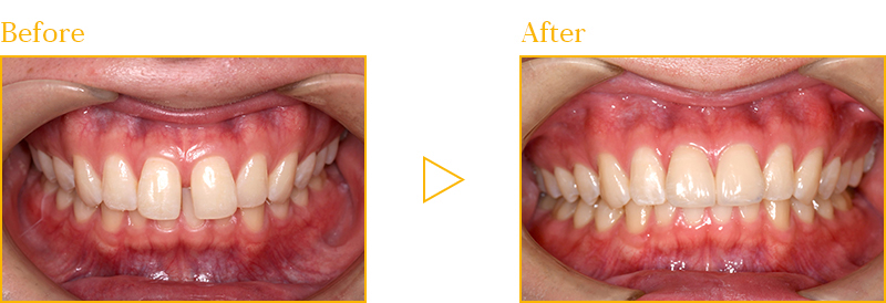前歯の隙間をラミネートベニアで治した症例