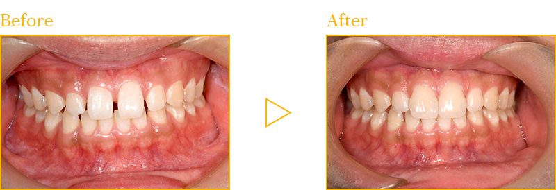 前歯の隙間をラミネートベニアで治した症例②